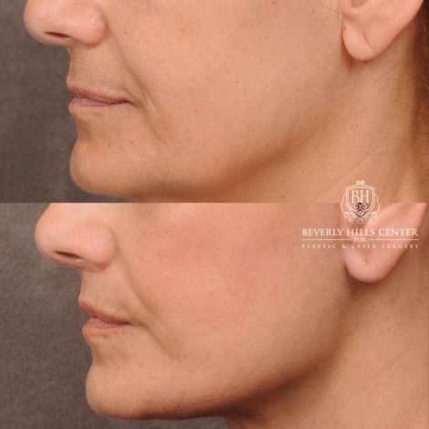 Beverly Hills Center Female Patient Before and After CUPID LIFT® Lip Lift, Comprehensive AuraLyft
