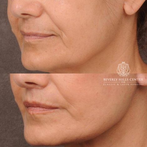 Beverly Hills Center Female Patient Before and After CUPID LIFT® Lip Lift, Comprehensive AuraLyft