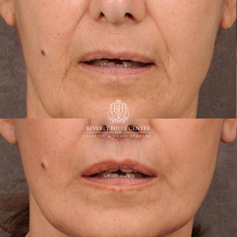 Beverly Hills Center Female Patient Before and After CUPID LIFT® Lip Lift, Comprehensive AuraLyft