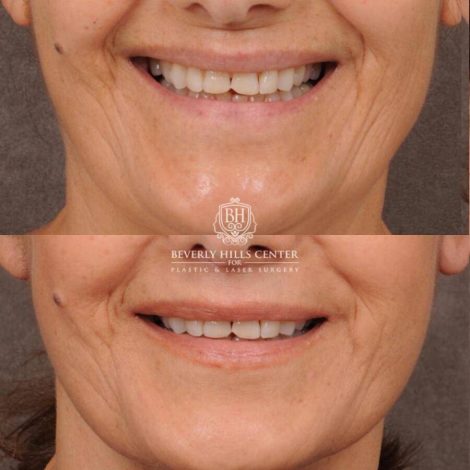 Beverly Hills Center Female Patient Before and After CUPID LIFT® Lip Lift, Comprehensive AuraLyft