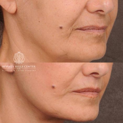 Beverly Hills Center Female Patient Before and After CUPID LIFT® Lip Lift, Comprehensive AuraLyft