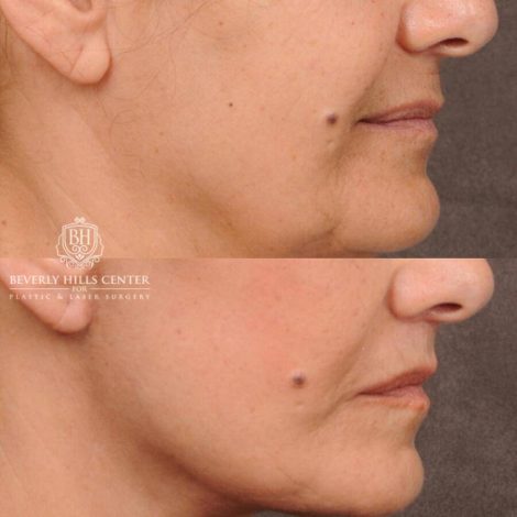 Beverly Hills Center Female Patient Before and After CUPID LIFT® Lip Lift, Comprehensive AuraLyft