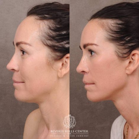 Beverly Hills Center Female Patient Before and After AuraLyft, Brow Lift, CUPID LIFT® Lip Lift