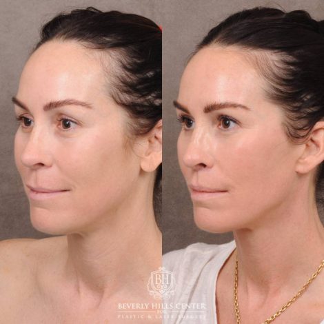 Beverly Hills Center Female Patient Before and After AuraLyft, Brow Lift, CUPID LIFT® Lip Lift