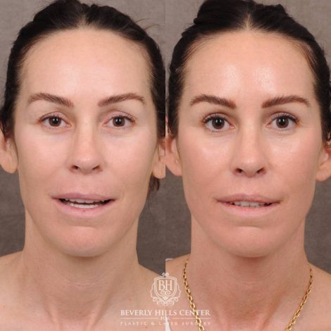 Beverly Hills Center Female Patient Before and After AuraLyft, Brow Lift, CUPID LIFT® Lip Lift