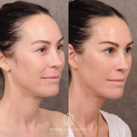 Beverly Hills Center Female Patient Before and After AuraLyft, Brow Lift, CUPID LIFT® Lip Lift