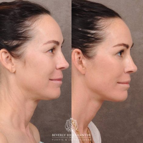 Beverly Hills Center Female Patient Before and After AuraLyft, Brow Lift, CUPID LIFT® Lip Lift