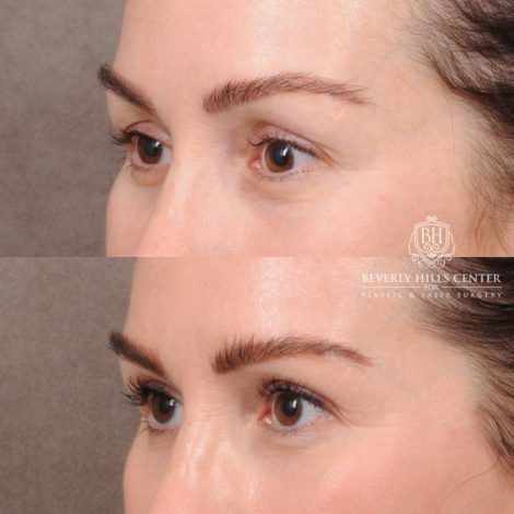 Beverly Hills Center Female Patient Before and After AuraLyft, Brow Lift, CUPID LIFT® Lip Lift