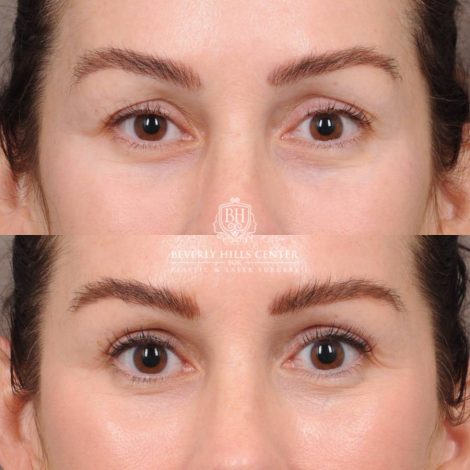 Beverly Hills Center Female Patient Before and After AuraLyft, Brow Lift, CUPID LIFT® Lip Lift