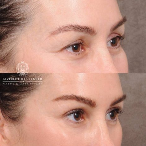 Beverly Hills Center Female Patient Before and After AuraLyft, Brow Lift, CUPID LIFT® Lip Lift