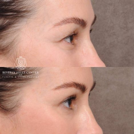 Beverly Hills Center Female Patient Before and After AuraLyft, Brow Lift, CUPID LIFT® Lip Lift