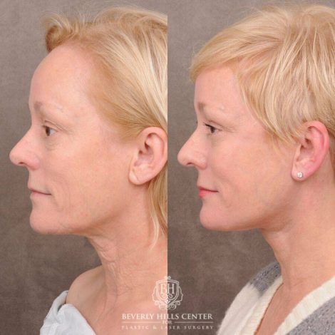 Beverly Hills Center Female Patient Before and After Auralyft, Upper and Lower Bleph, Fat Grafting, CUPID LIFT® Lip Lift w Corners Type 2