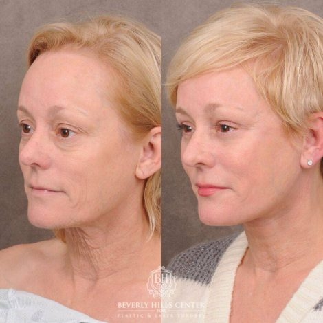 Beverly Hills Center Female Patient Before and After Auralyft, Upper and Lower Bleph, Fat Grafting, CUPID LIFT® Lip Lift w Corners Type 2