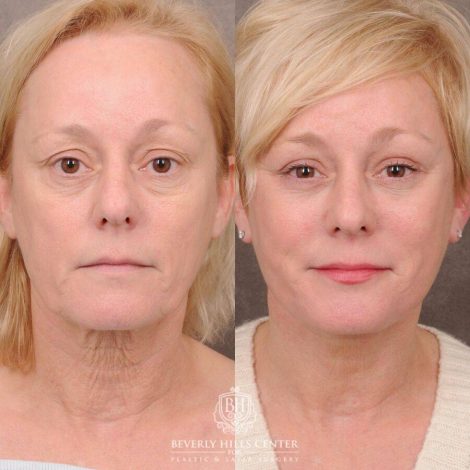 Beverly Hills Center Female Patient Before and After Auralyft, Upper and Lower Bleph, Fat Grafting, CUPID LIFT® Lip Lift w Corners Type 2