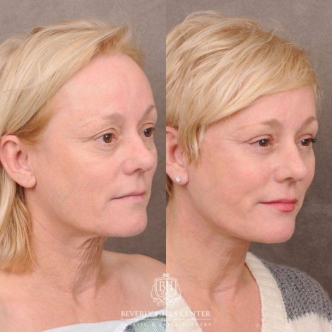 Beverly Hills Center Female Patient Before and After Auralyft, Upper and Lower Bleph, Fat Grafting, CUPID LIFT® Lip Lift w Corners Type 2