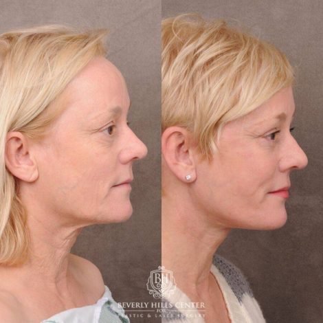 Beverly Hills Center Female Patient Before and After Auralyft, Upper and Lower Bleph, Fat Grafting, CUPID LIFT® Lip Lift w Corners Type 2