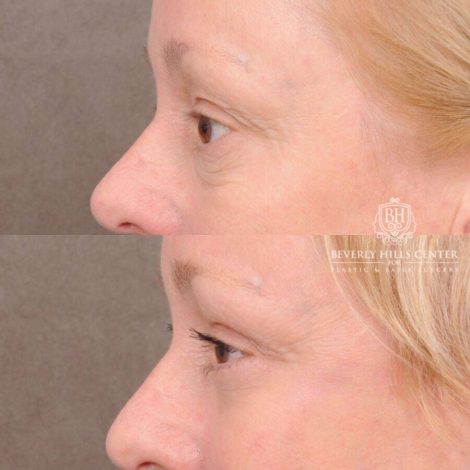 Beverly Hills Center Female Patient Before and After Auralyft, Upper and Lower Bleph, Fat Grafting, CUPID LIFT® Lip Lift w Corners Type 2