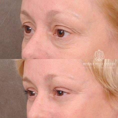 Beverly Hills Center Female Patient Before and After Auralyft, Upper and Lower Bleph, Fat Grafting, CUPID LIFT® Lip Lift w Corners Type 2