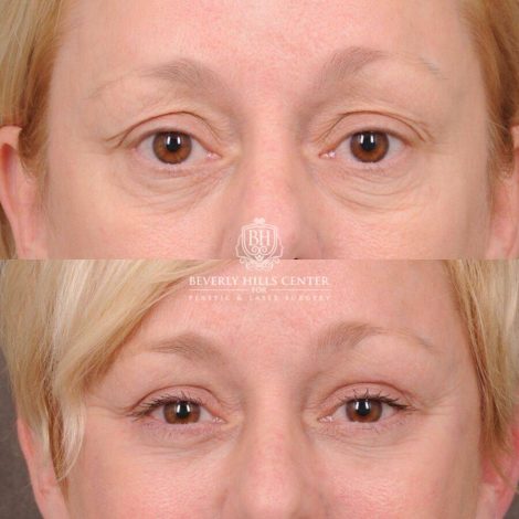 Beverly Hills Center Female Patient Before and After Auralyft, Upper and Lower Bleph, Fat Grafting, CUPID LIFT® Lip Lift w Corners Type 2