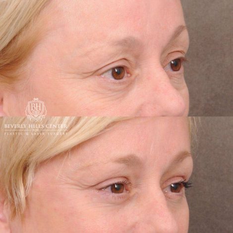 Beverly Hills Center Female Patient Before and After Auralyft, Upper and Lower Bleph, Fat Grafting, CUPID LIFT® Lip Lift w Corners Type 2
