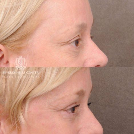 Beverly Hills Center Female Patient Before and After Auralyft, Upper and Lower Bleph, Fat Grafting, CUPID LIFT® Lip Lift w Corners Type 2