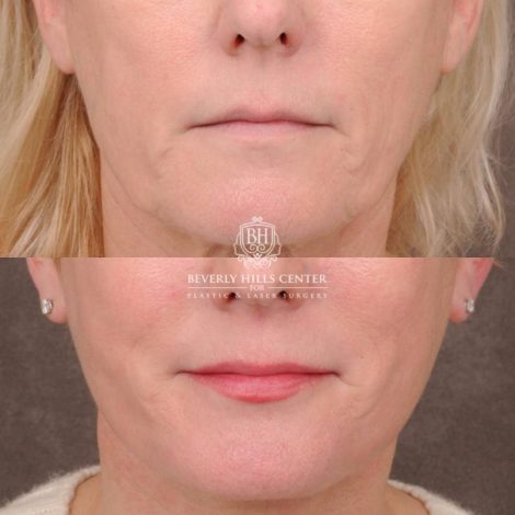 Beverly Hills Center Female Patient Before and After Auralyft, Upper and Lower Bleph, Fat Grafting, CUPID LIFT® Lip Lift w Corners Type 2