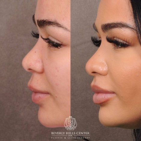 Beverly Hills Center Female Patient Before and After CUPID LIFT® Lift