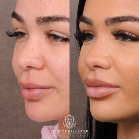 Beverly Hills Center Female Patient Before and After CUPID LIFT® Lift