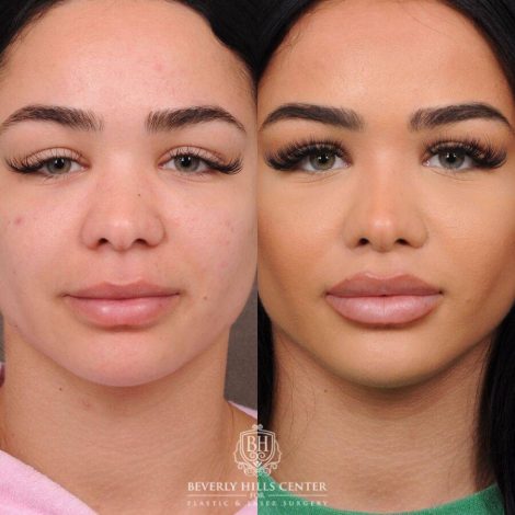 Beverly Hills Center Female Patient Before and After CUPID LIFT® Lift