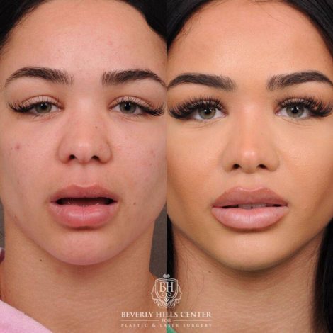 Beverly Hills Center Female Patient Before and After CUPID LIFT® Lift