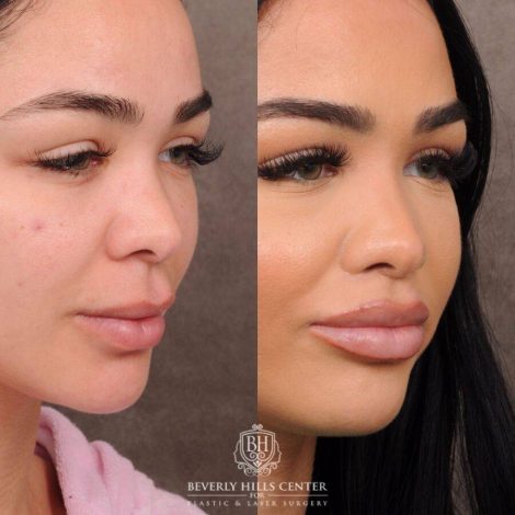 Beverly Hills Center Female Patient Before and After CUPID LIFT® Lift