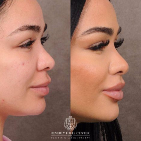 Beverly Hills Center Female Patient Before and After CUPID LIFT® Lift