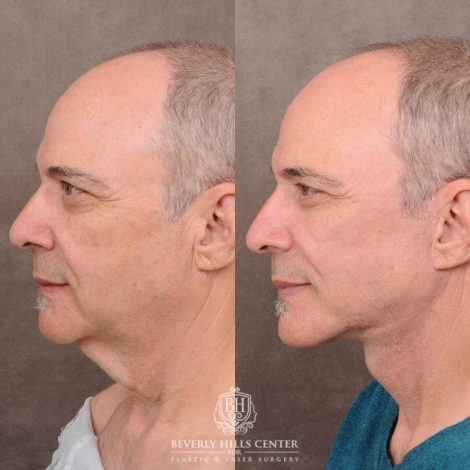 Beverly Hills Center Male Patient Before and After AuraLyft with Fat Grafting