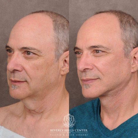Beverly Hills Center Male Patient Before and After AuraLyft with Fat Grafting