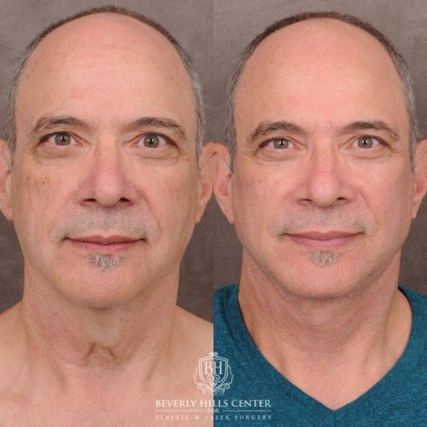 Beverly Hills Center Male Patient Before and After AuraLyft with Fat Grafting