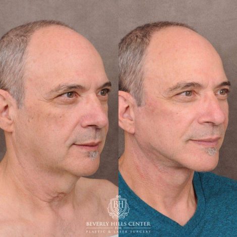Beverly Hills Center Male Patient Before and After AuraLyft with Fat Grafting
