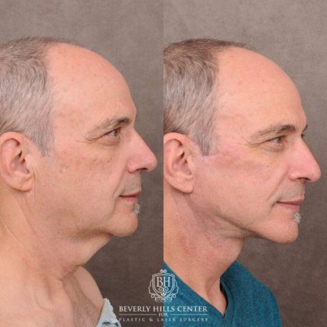 Beverly Hills Center Male Patient Before and After AuraLyft with Fat Grafting