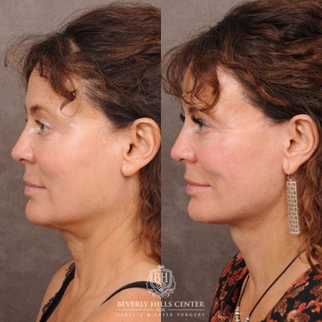 Beverly Hills Center Female Patient Before and After AuraLyft™️ and nothing else