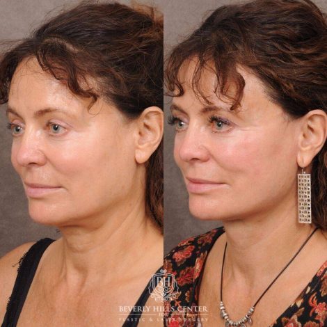 Beverly Hills Center Female Patient Before and After AuraLyft™️ and nothing else
