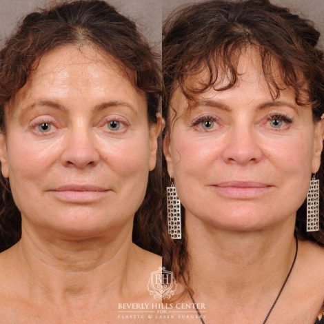 Beverly Hills Center Female Patient Before and After AuraLyft™️ and nothing else
