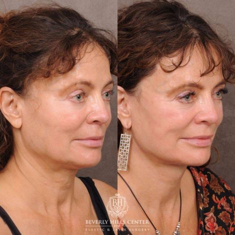 Beverly Hills Center Female Patient Before and After AuraLyft™️ and nothing else