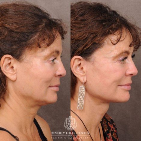 Beverly Hills Center Female Patient Before and After AuraLyft™️ and nothing else