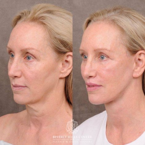 Beverly Hills Center Female Patient Before and After Comprehensive AuraLyft, CUPID LIFT® Lip Lift, Upper & Lower Blepharoplasty