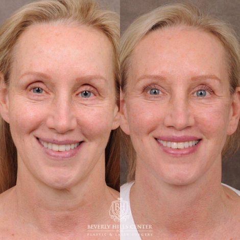Beverly Hills Center Female Patient Before and After Comprehensive AuraLyft, CUPID LIFT® Lip Lift, Upper & Lower Blepharoplasty