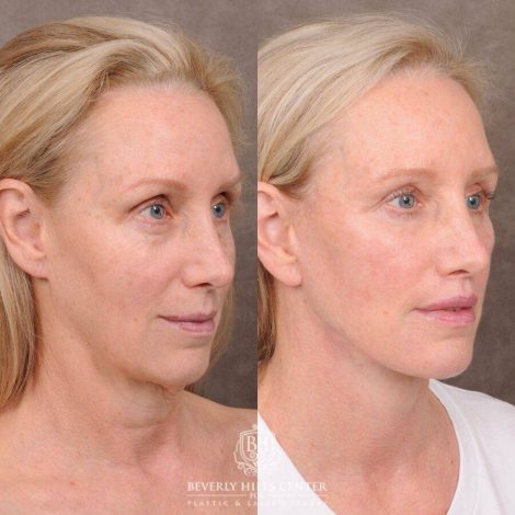 Beverly Hills Center Female Patient Before and After Comprehensive AuraLyft, CUPID LIFT® Lip Lift, Upper & Lower Blepharoplasty