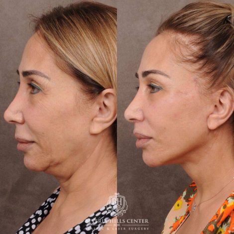 Beverly Hills Center Female Patient Before and After AuraLyft, Mini CUPID LIFT® Lip Lift, Upper Eyelids
