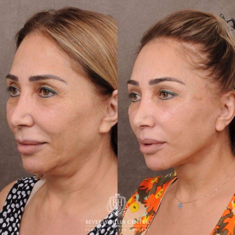 Beverly Hills Center Female Patient Before and After AuraLyft, Mini CUPID LIFT® Lip Lift, Upper Eyelids