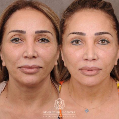 Beverly Hills Center Female Patient Before and After AuraLyft, Mini CUPID LIFT® Lip Lift, Upper Eyelids