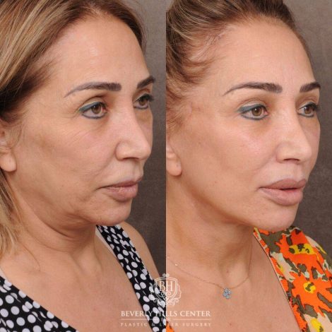 Beverly Hills Center Female Patient Before and After AuraLyft, Mini CUPID LIFT® Lip Lift, Upper Eyelids
