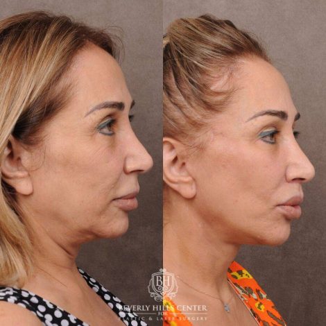 Beverly Hills Center Female Patient Before and After AuraLyft, Mini CUPID LIFT® Lip Lift, Upper Eyelids